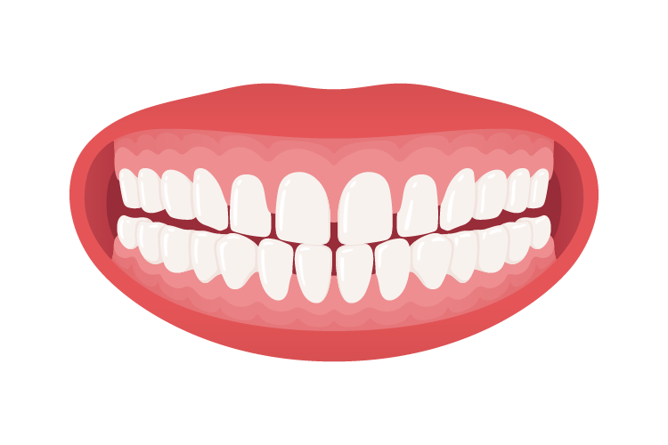 6-rastresitost-zuba Rastresitost Zuba u Vilici