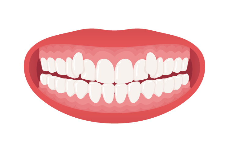 8-ektopija-zuba Ektopija Zuba